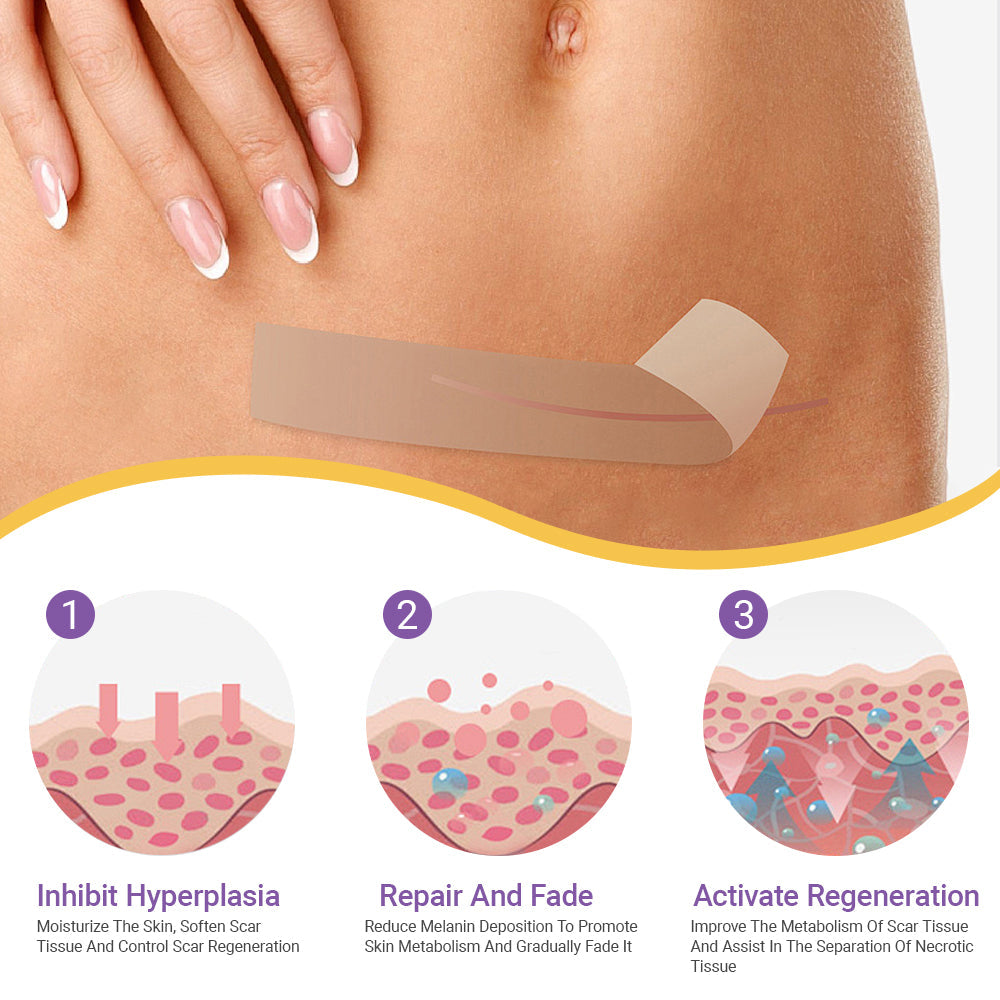 BBOJI® Hyaluronic Acid Nano-Microneedle Repair Tape🏥 (treats new and old scars, reduces surgical scars, stretch marks, keloids, acne, burns, warts, dermatomes and varicose veins)