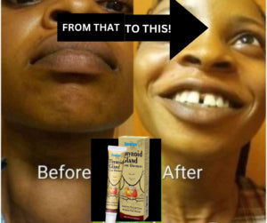 Sumiphen Thyroid Care Ointment | Topical ointment used to relieve goiter, sore throat, and pain from thyroid nodules.