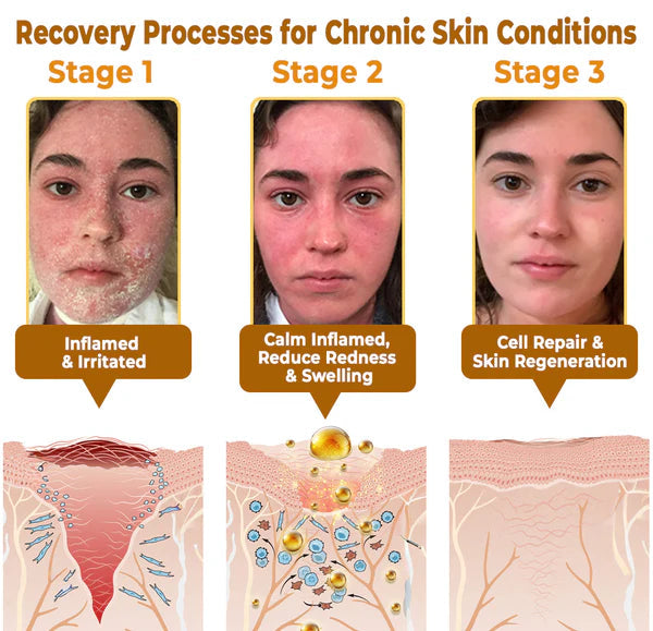 BeeRx™ Cream | Finally Break Free From The Endless Cycle of Failed Creams, Harsh Steroids & Empty Promises